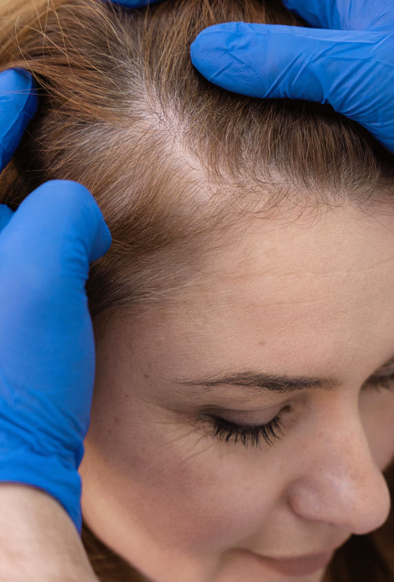 Kadın Saç Ekimi